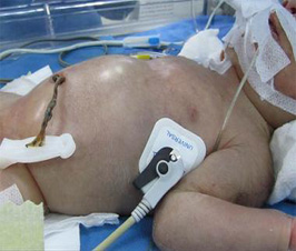 La Enfermedad de Megacolon afecta a 1 de cada 5000